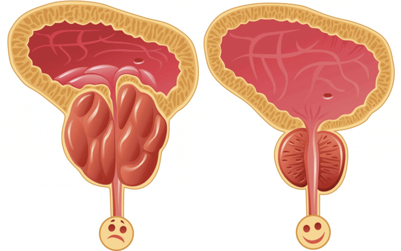 oorzaken van potentieproblemen bij mannen